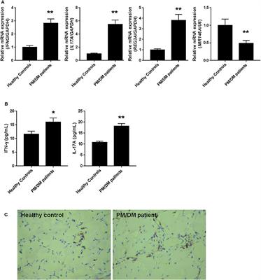 Reduced miR-146a Promotes REG3A Expression and Macrophage Migration in Polymyositis and Dermatomyositis